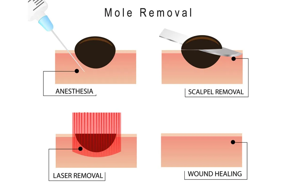 Removal Methods We Offer