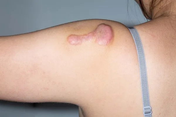 What is a Keloid?