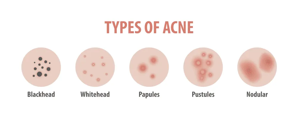 Types of Acne We Treat